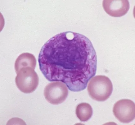 Acute Myeloid Leukemia