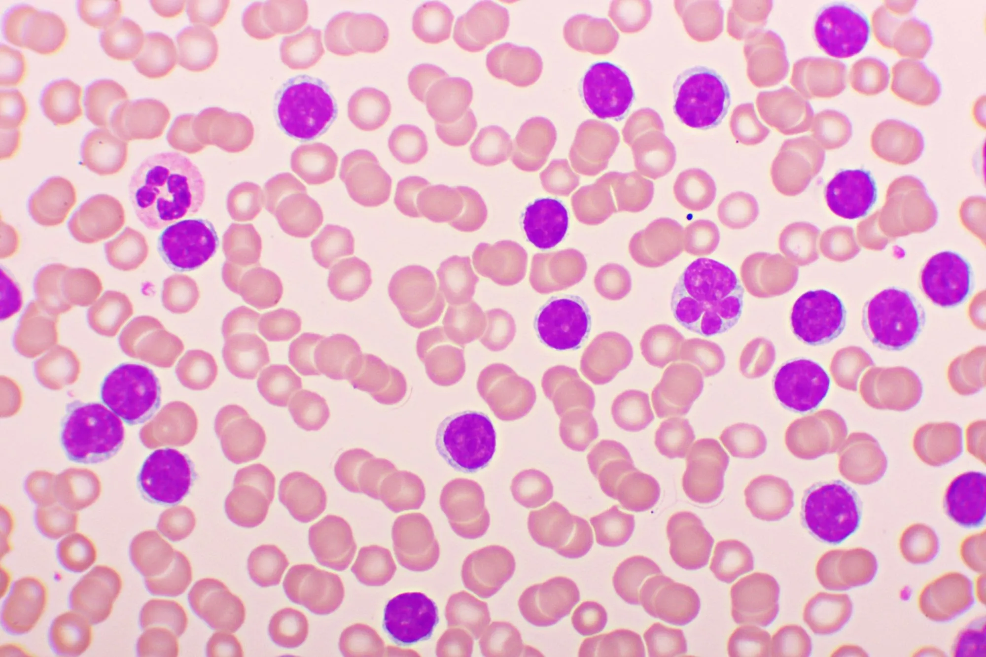 Acute lymphoblastic leukemia