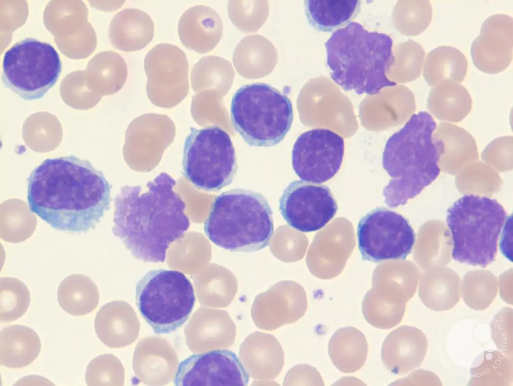 Chronic Lymphocytic Leukemia