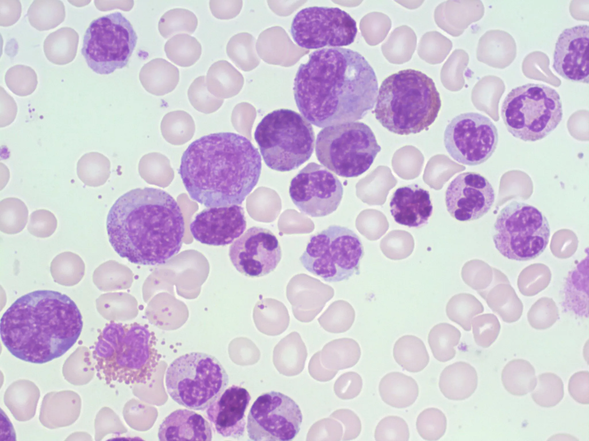 Chronic Myeloid Leukemia