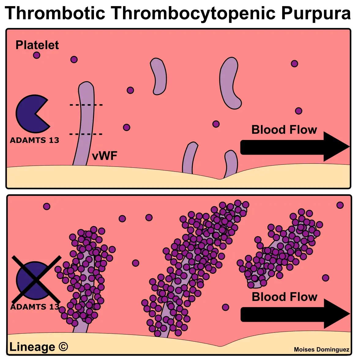 TTP Pathophysiology